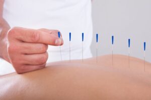 Acupuncture therapy, Needles, Relief, Acupuncture, Therapy, Pain, Acupuncture therapy in delhi