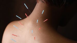 Acupuncture therapy, Needles, Relief, Acupuncture, Therapy, Pain, Acupuncture therapy in delhi