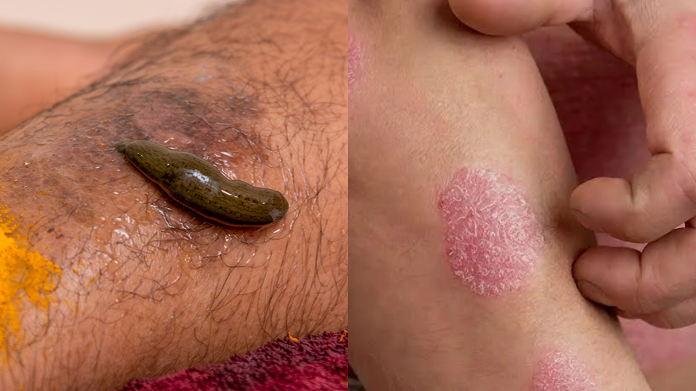 Can leech therapy cure varicose veins? – Vascular Care Expert
