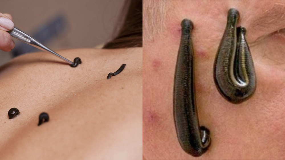 Skin Deep: Leech Therapy for Radiant and Healthy Skin - SPPC Patanjali  Wellness Center
