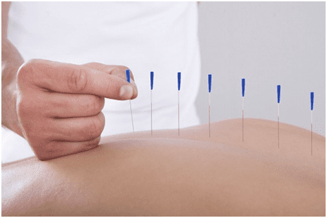 Acupuncture Treatment Work for Pain Relief
