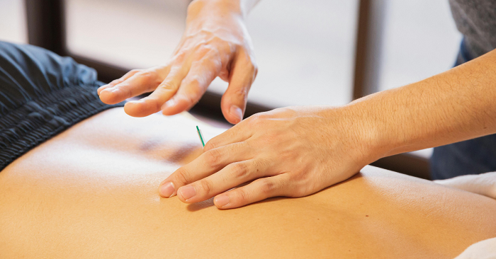 Acupuncture for Pain Relief